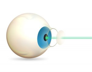 laser lasik eye surgery